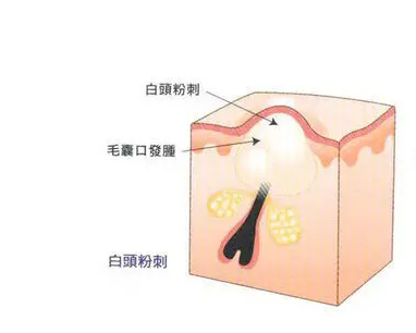 长痘的原因及调理方法