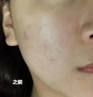 多年的痘坑可以去除吗
