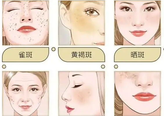 色斑的分类