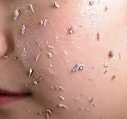 揭秘皮肤粗糙暗沉的原因 教你如何改善皮肤暗沉