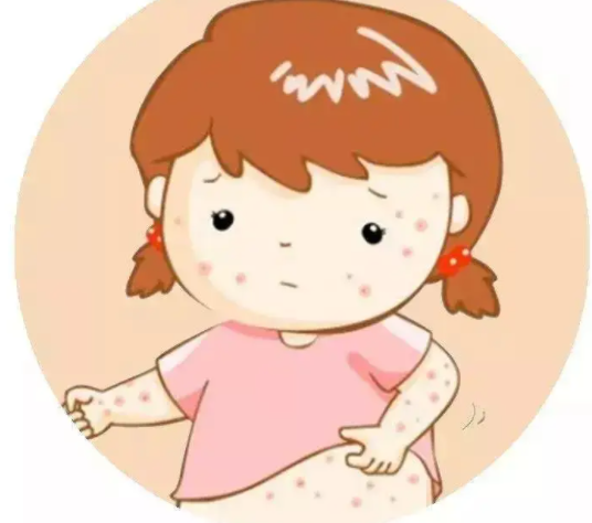 水痘多长时间能好 水痘其实没那么可怕