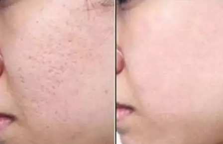 痘坑能恢复到正常皮肤吗 痘疤痘坑要怎么修复