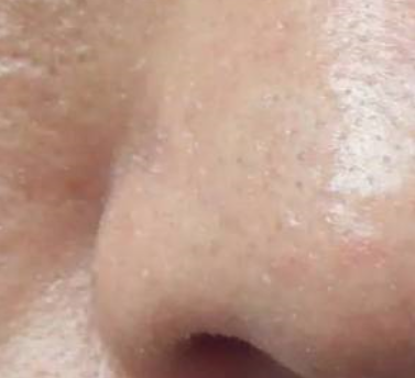 额头毛孔粗大怎么办