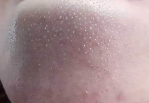 粉刺是什么样子
