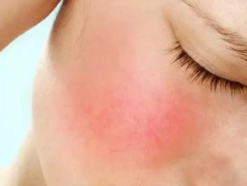 红血丝如何修复