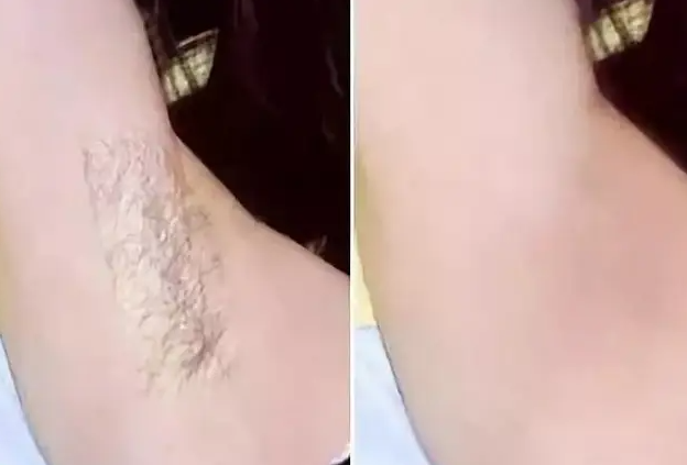 健康脱毛的方法