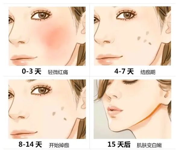 科学有效的激光祛斑方法
