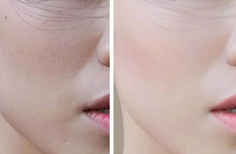 脸上黑色素沉淀怎么去除