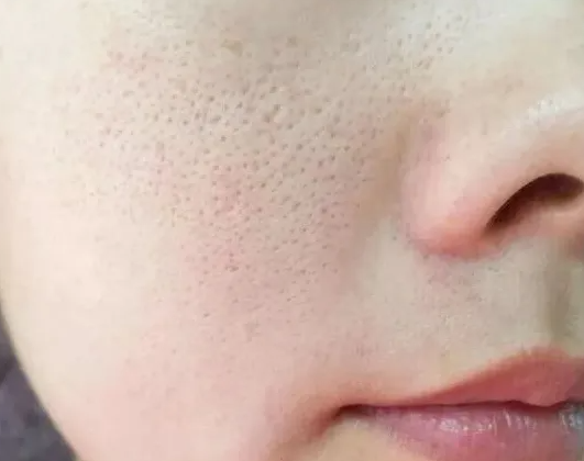 面部毛孔粗大的原因 油脂分泌多