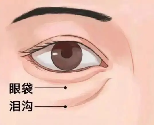 有没有不手术去眼袋的方法 眼袋的形成原因