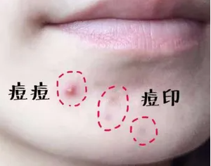 下巴长痘是什么原因 下巴长痘消除方法推荐