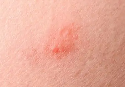 皮肤过敏的症状有哪些