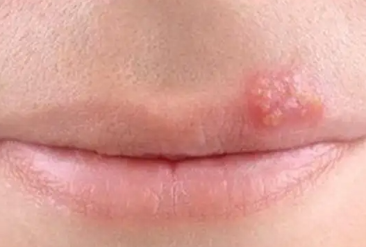 嘴唇上长泡应该怎么办 唇上长有小水泡的预防保健