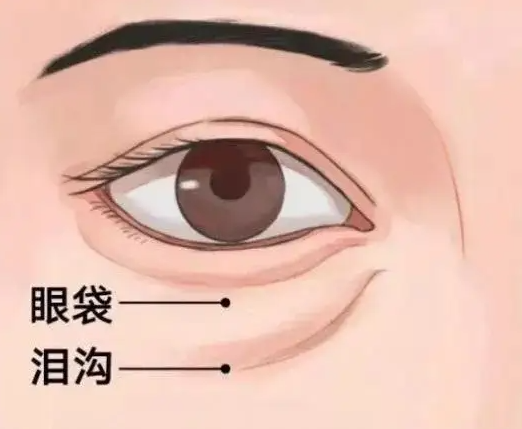 眼袋深怎么去除