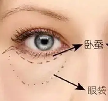 眼袋太重怎么办 预防眼袋的方法