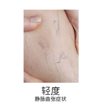 女性静脉曲张早期图片 女性静脉曲张早期症状