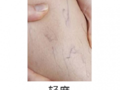 女性静脉曲张早期图片 女性静脉曲张早期症状