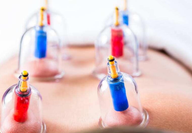 中医拔罐减肥疗法怎么做？(拔罐减肥手法)