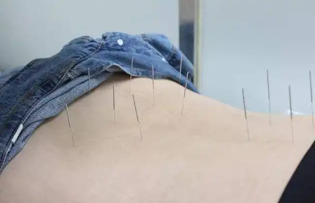 你知道针灸减肥多久能瘦下来吗